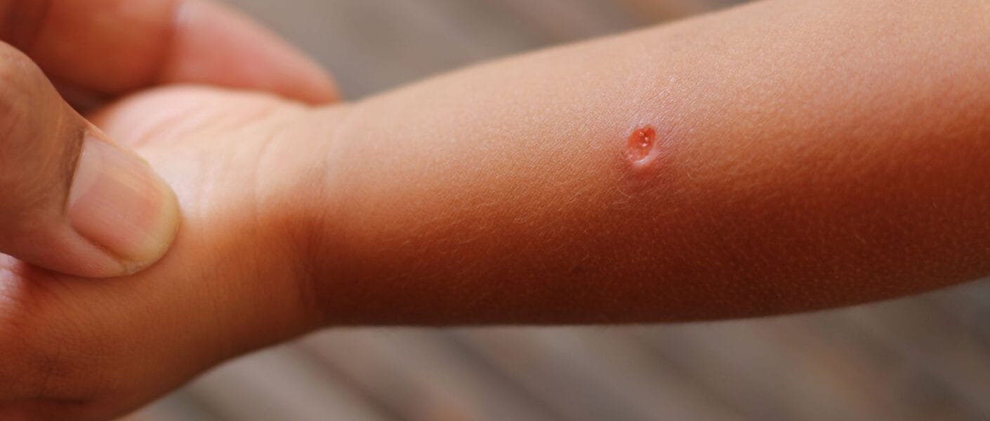 picadas de insetos em bebês