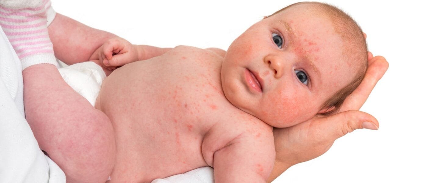 dengue em bebê