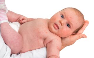 dengue em bebês e crianças