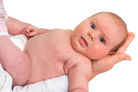 dengue em bebês e crianças