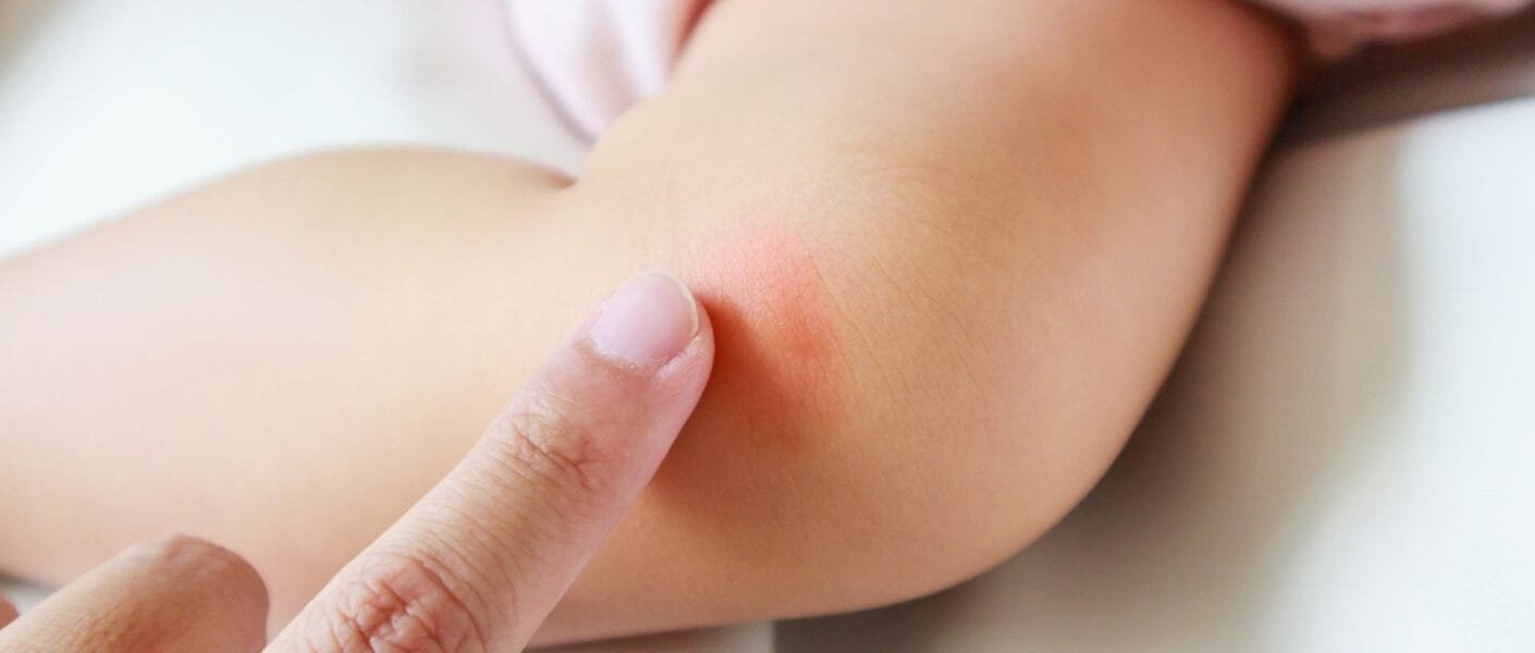 Manchas de Dengue em Bebês