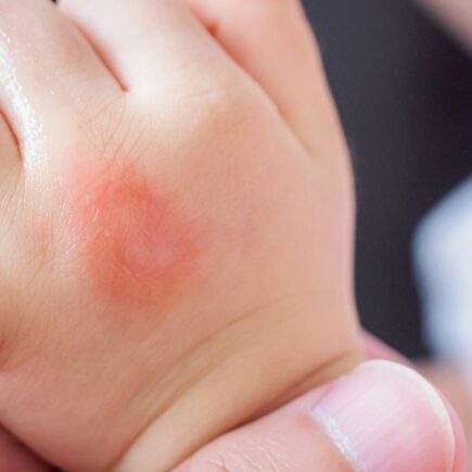 Sintomas de Dengue em Bebês