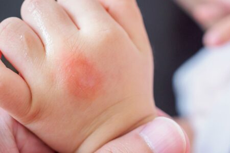 Sintomas de Dengue em Bebês