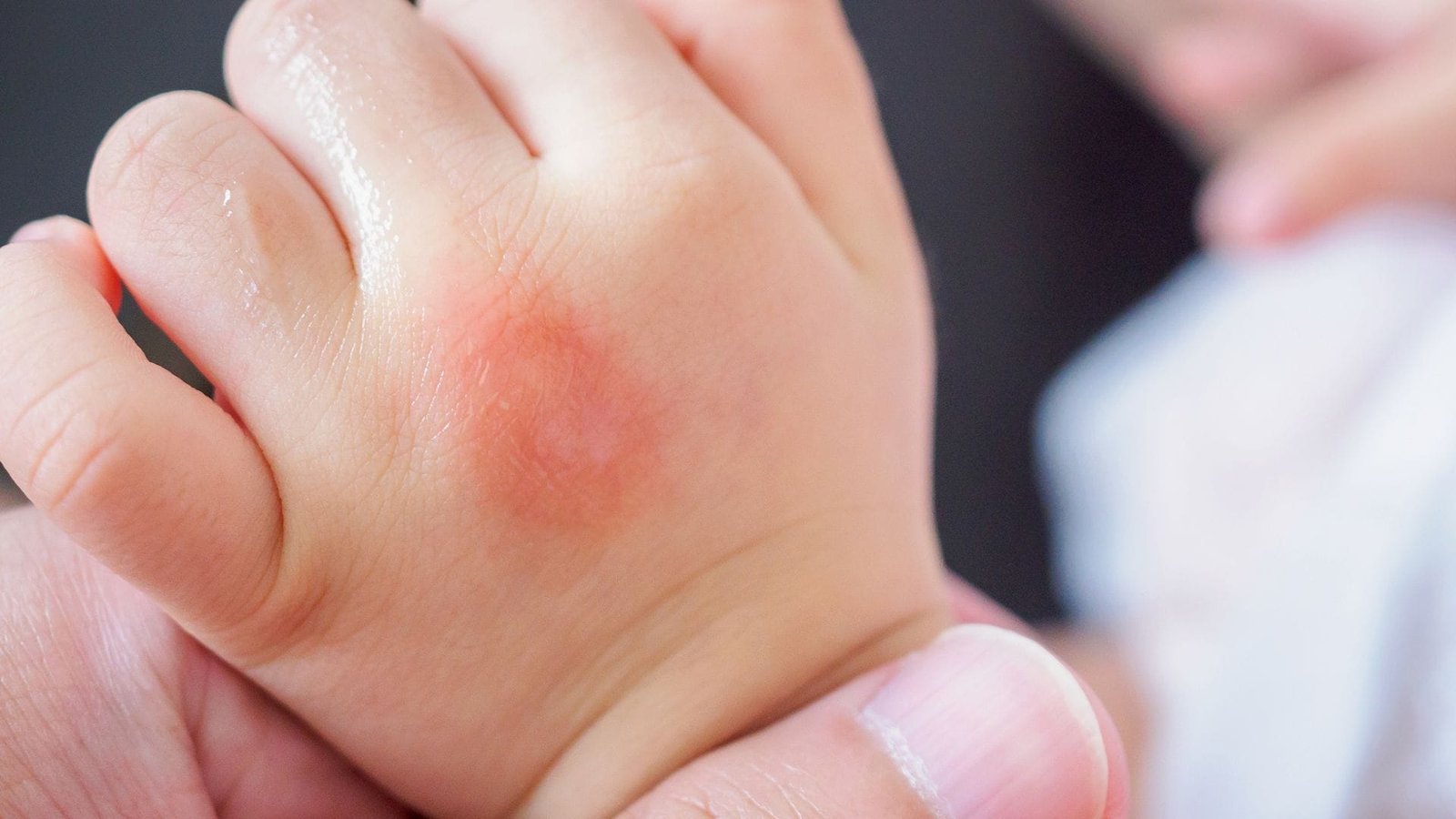 Dengue Sintomas: Guia completo para identificar rápido