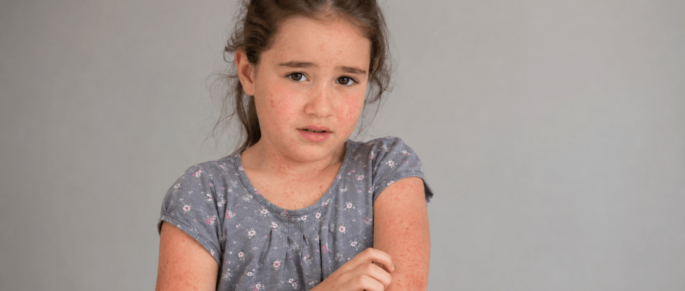 Crie uma foto 16:9 de uma menina apresentando sinais de erupçao na pele