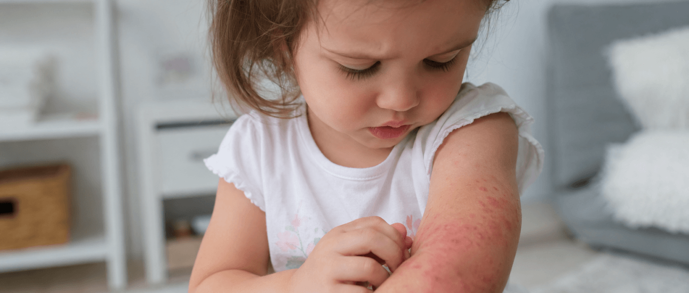 Dermatite atópica infantil: sinais que merecem atenção