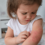 Dermatite atópica infantil: sinais que merecem atenção