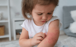 Dermatite atópica infantil: sinais que merecem atenção