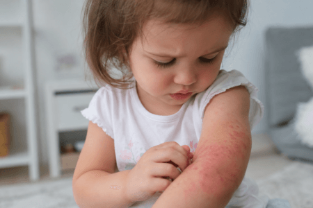 Dermatite atópica infantil: sinais que merecem atenção