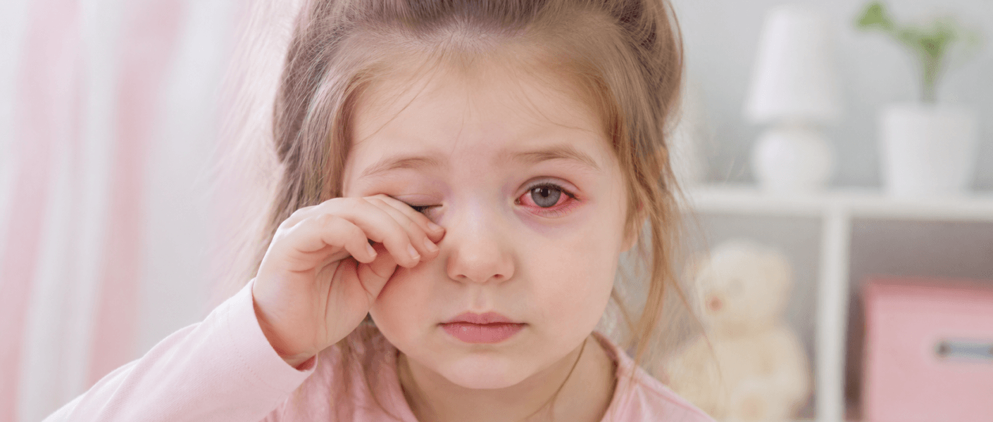 Criança coçando os olhos o tempo todo: alergia ou conjuntivite?