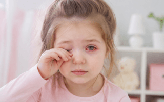 Criança coçando os olhos o tempo todo: alergia ou conjuntivite?